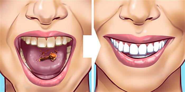 10 modi per rimuovere il tartaro accumulato sui denti