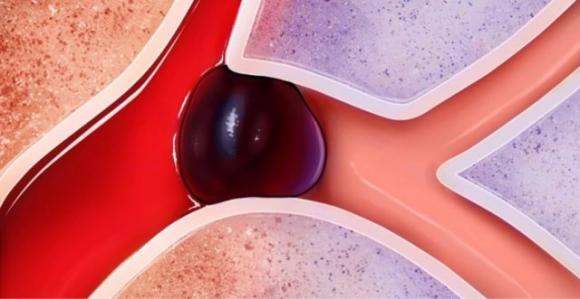 8 metodi efficaci per prevenire l’ictus, sbarazzarsi del mal di testa e della stanchezza