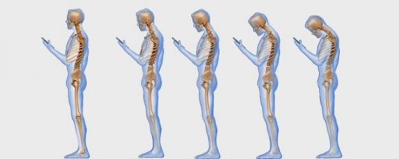 Troppi smartphone e tablet: il “collo da tablet” diventa una vera e propria epidemia