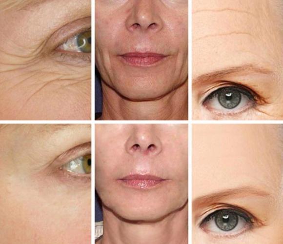 5 rimedi naturali per combattere le rughe senza dover ricorrere alle iniezioni di bellezza
