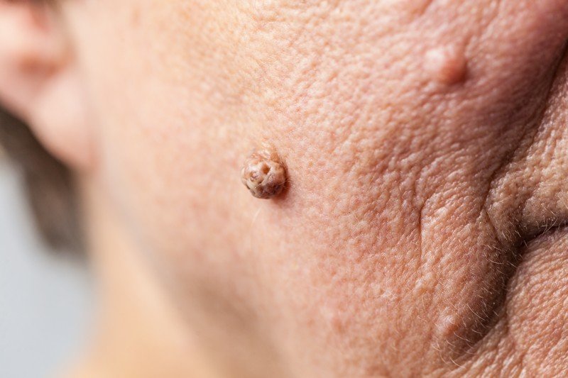 I porri della pelle interessano soprattutto le donne sopra i 50 anni