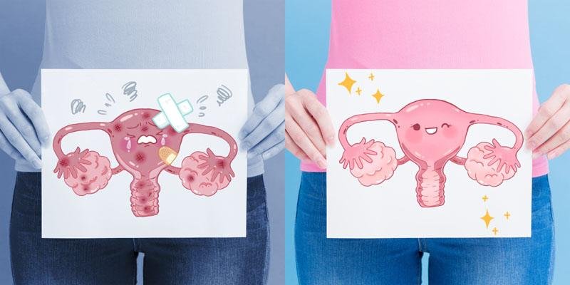 L'utero fibromatoso porta alla formazione di fibromi in più punti