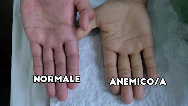 Alcuni segnali che soffri di anemia e come curarla