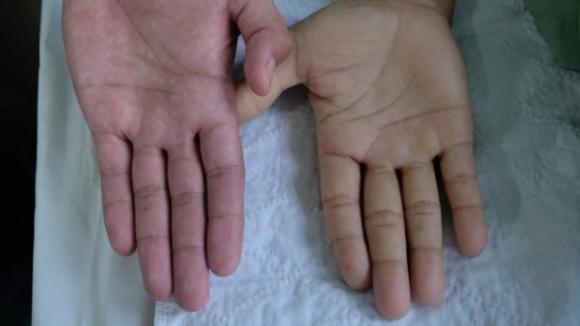 Alcuni segnali che soffri di anemia e come curarla