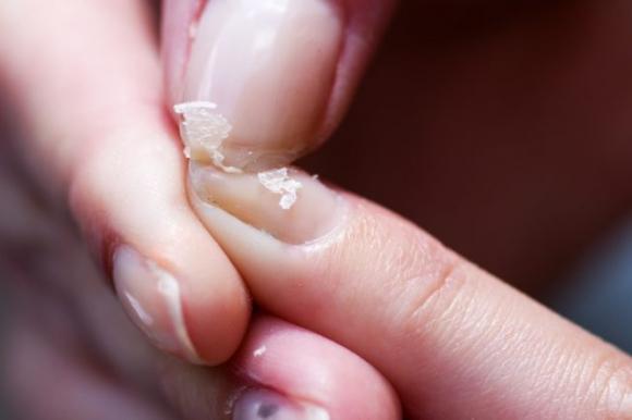 Alcuni segnali che soffri di anemia e come curarla