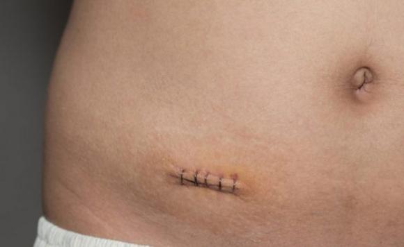 Chi non ha più l’appendice ha meno probabilità di ammalarsi di Parkinson