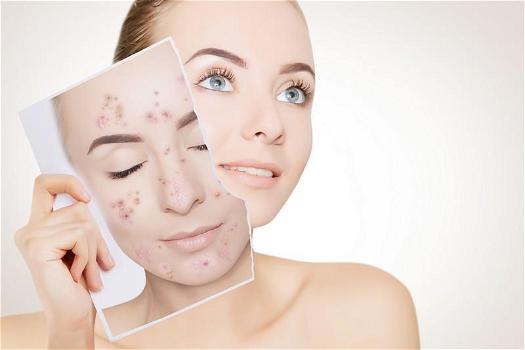 Come eliminare le cicatrici da acne e brufoli