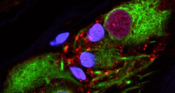 Chi non ha più l’appendice ha meno probabilità di ammalarsi di Parkinson