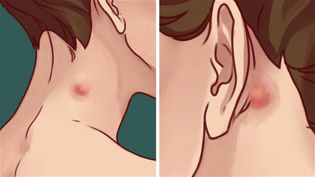 Hai notato un piccolo nodulo sul collo o dietro all’orecchio? Ecco cosa sono e quando dovresti preoccuparti: