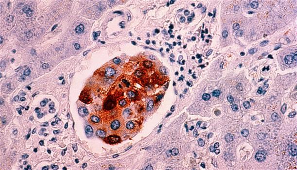 Scoperte cellule immunitarie TIL: nasce la speranza nella lotta contro il cancro al seno