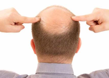 Alcuni ricercatori nella lotta al cancro hanno trovato casualmente una cura genetica per la calvizie