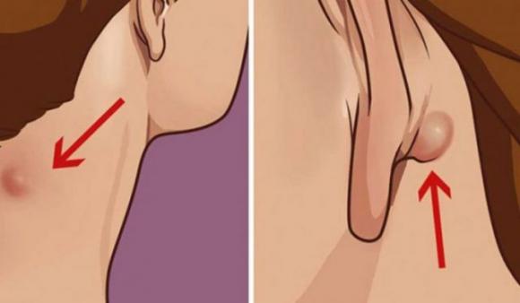 Hai notato un piccolo nodulo sul collo o dietro all’orecchio? Ecco cosa sono e quando dovresti preoccuparti: