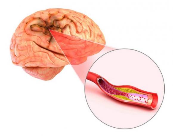 Ecco come puoi salvare una persona colpita da ictus cerebrale utilizzando solo un ago