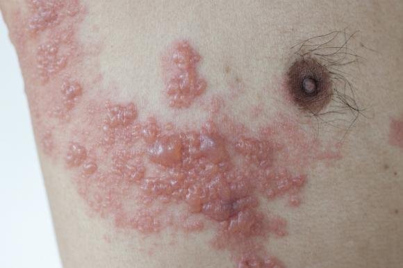 Il Fuoco o Sfogo di Sant'Antonio è una malattia infettiva che deriva dalla riattivazione del Virus Varicella-Zoster (VZV). 