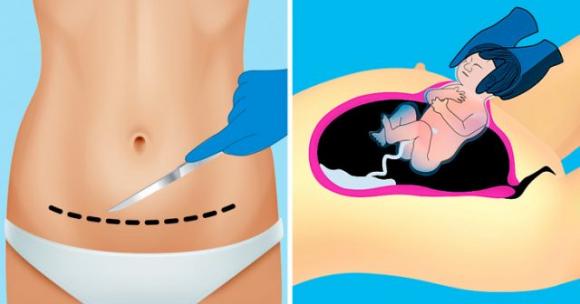 Recupero dopo il parto cesareo: 10 cose da fare e come affrontare i giorni dopo l’operazione