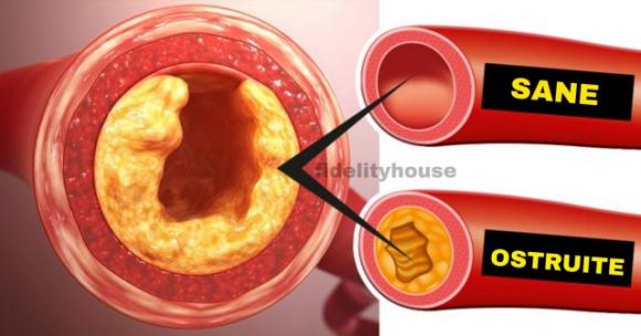 Arterie ostruite: i 12 cibi che fanno male al cuore e alla circolazione