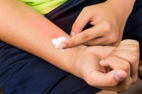 Questo è il rimedio più efficace contro le zanzare: può fare davvero miracoli