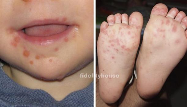 “Mani-piedi-bocca”, la malattia infettiva che colpisce i bambini: attenzione ai sintomi