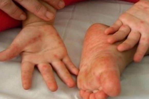 “Mani-piedi-bocca”, la malattia infettiva che colpisce i bambini: attenzione ai sintomi