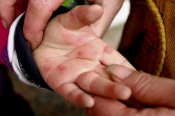 “Mani-piedi-bocca”, la malattia infettiva che colpisce i bambini: attenzione ai sintomi