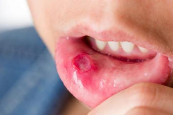 “Mani-piedi-bocca”, la malattia infettiva che colpisce i bambini: attenzione ai sintomi