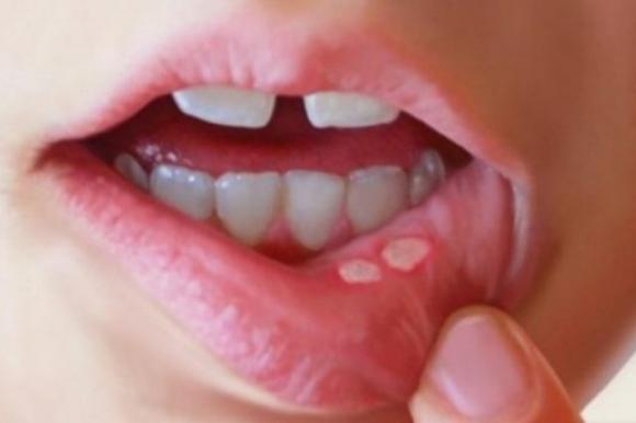 “Mani-piedi-bocca”, la malattia infettiva che colpisce i bambini: attenzione ai sintomi