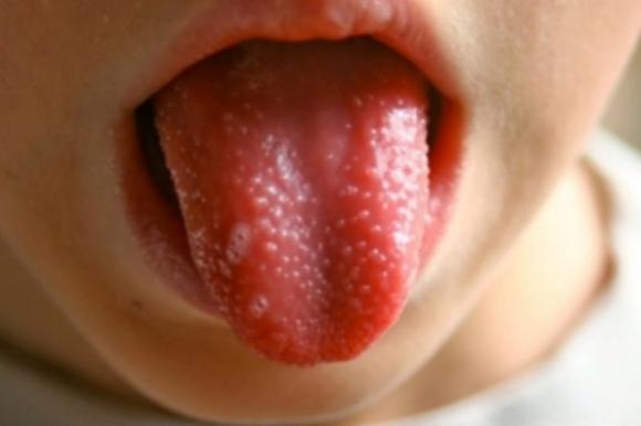 “Mani-piedi-bocca”, la malattia infettiva che colpisce i bambini: attenzione ai sintomi