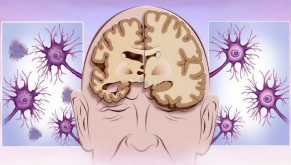 Alzheimer, il sintomo della malattia fino a 20 anni prima