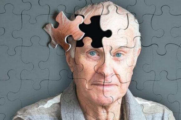 Alzheimer, il sintomo della malattia fino a 20 anni prima