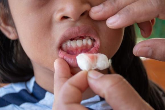 Gengive sanguinanti, quali rimedi adottare? Ecco 10 consigli degli esperti