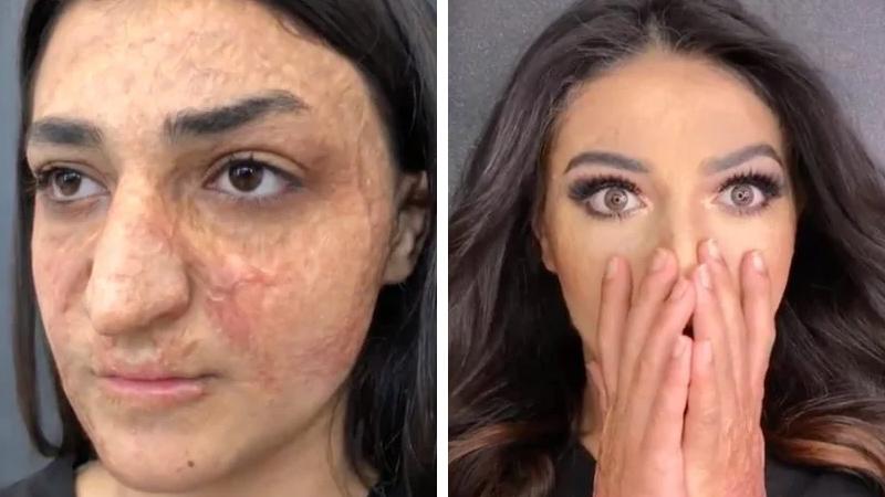 Le ustioni le deturpavano il viso: un make-up artist riaccende il sorriso di questa donna