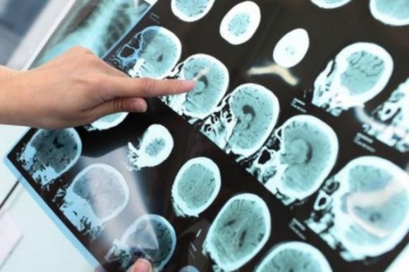 L’olio extra-vergine di oliva protegge il cervello dall’Alzheimer