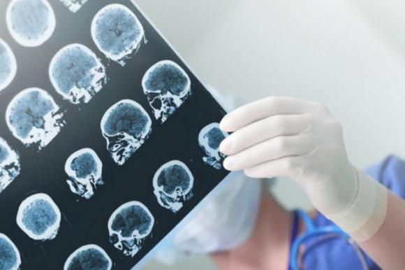 L’olio extra-vergine di oliva protegge il cervello dall’Alzheimer