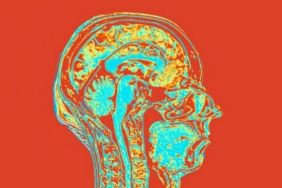 Lo stress e la depressione rimpiccioliscono il cervello, lo rivela uno studio