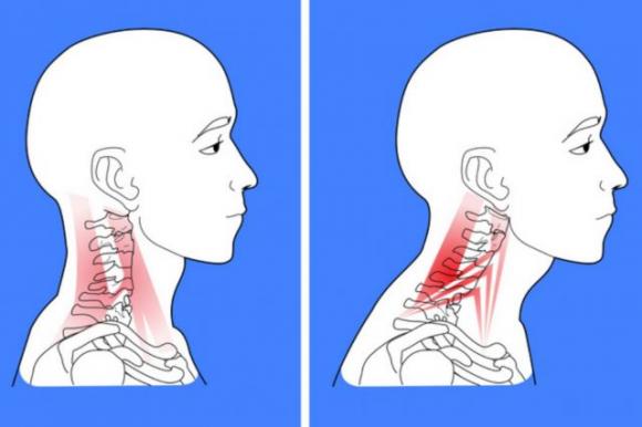 Gli smartphone stanno trasformando il nostro cranio: sempre più giovani hanno delle strane spine ossee