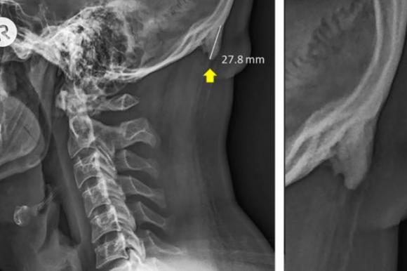 Gli smartphone stanno trasformando il nostro cranio: sempre più giovani hanno delle strane spine ossee