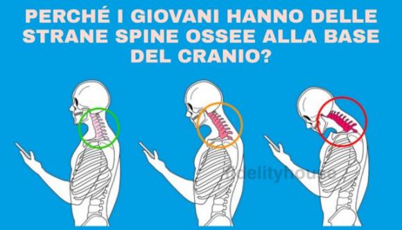 Gli smartphone stanno trasformando il nostro cranio: sempre più giovani hanno delle strane spine ossee