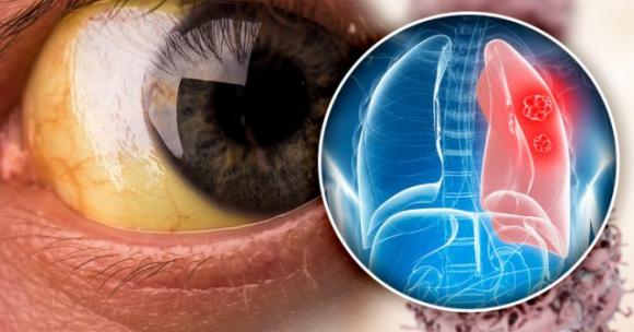 5 segnali che possono indicare un problema ai polmoni: non sottovalutarli