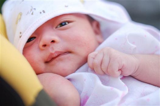 Acne neonatale: cause e rimedi per i brufoli del neonato