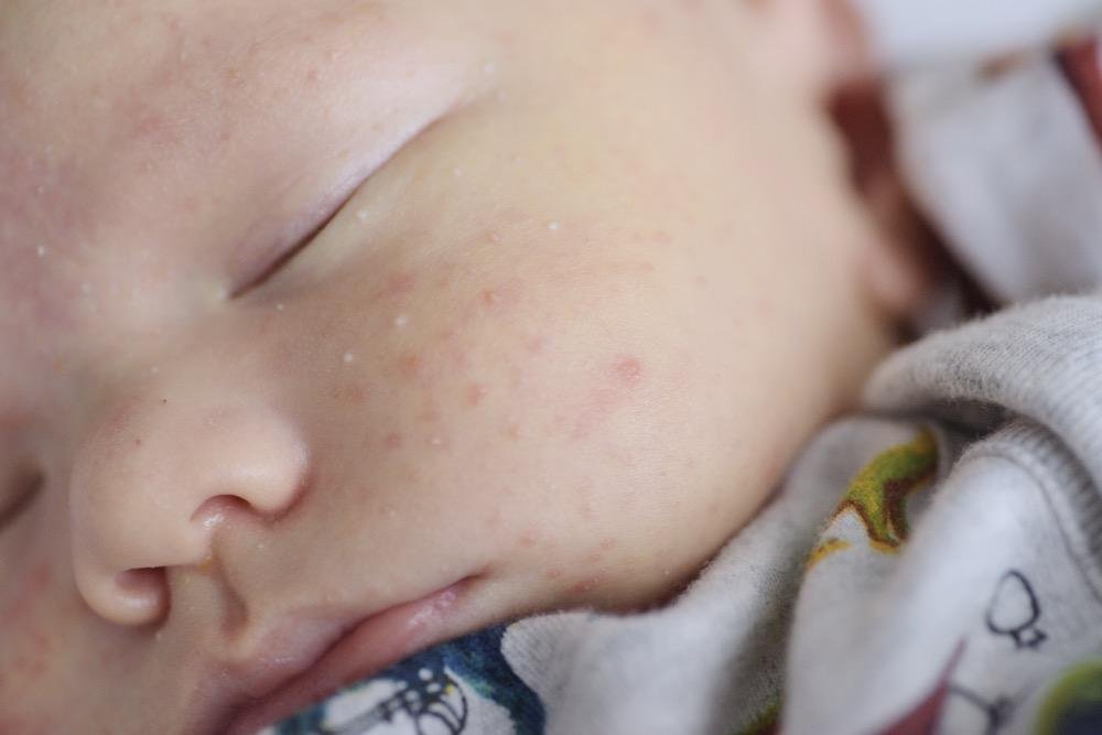 L'acne del neonato riguarda soprattutto fronte e guance