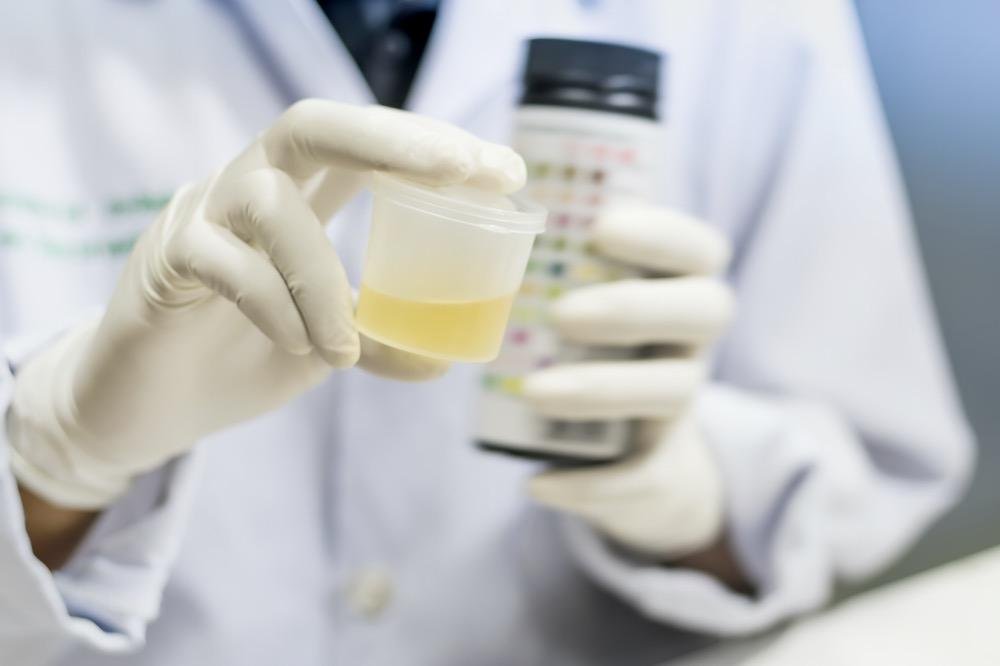 Cellule epiteliali nelle urine: cosa sono, tipi e valori normali