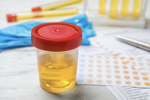 Cellule epiteliali nelle urine: cosa sono, tipi e valori normali
