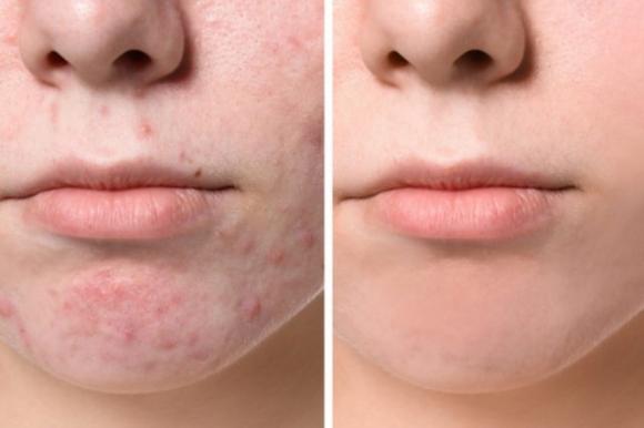 Olio di ricino, un vero elisir di bellezza. Ecco tutti i suoi benefici per il tuo corpo