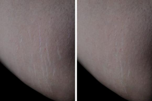 Olio di ricino, un vero elisir di bellezza. Ecco tutti i suoi benefici per il tuo corpo