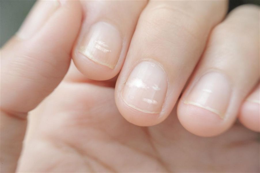 Fra le varie patologie delle unghie, l'ingiallimento e le macchie sono quelle più diffuse