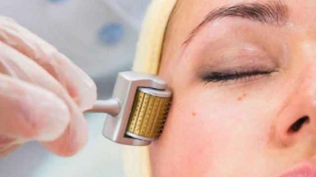 Il micro needling: la tecnica casalinga per ridurre visibilmente le rughe