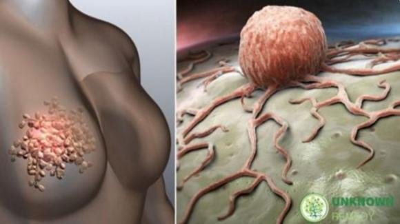 Alcuni sintomi del tumore al seno che le donne devono smettere di ignorare