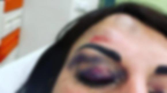 “Ecco il mio ex compagno”, la Vip italiana picchiata a sangue
