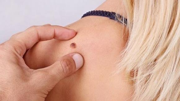 Cancro della pelle: se hai uno di questi 5 campanelli d’allarme corri subito dal dermatologo
