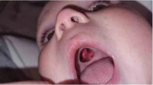 I genitori scoprono un buco in bocca del figlio e corrono in ospedale